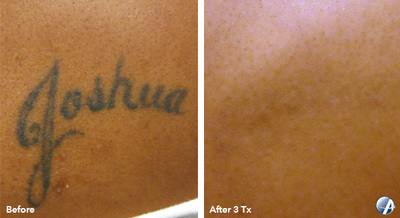 Tattoo removal before and after result 1