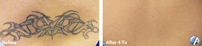 Tattoo removal before and after result 10