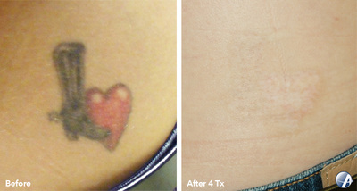 Tattoo removal before and after result 11