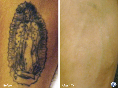 Tattoo removal before and after result 12