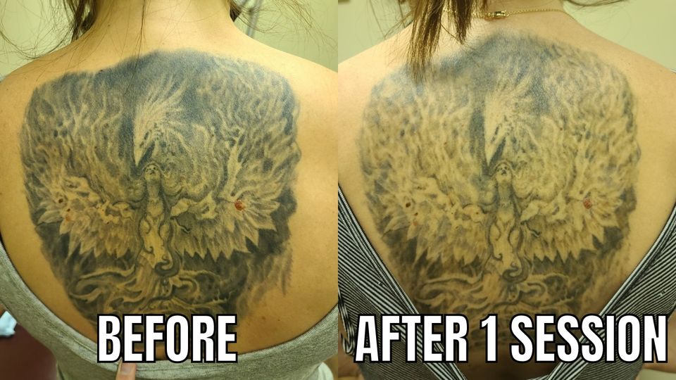 Tattoo removal before and after result 2