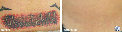 Tattoo removal before and after result 3