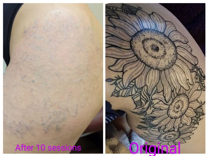 Tattoo removal before and after result 5