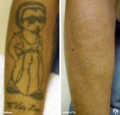 Tattoo removal before and after result 6