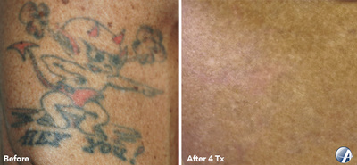 Tattoo removal before and after result 7