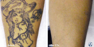 Tattoo removal before and after result 8