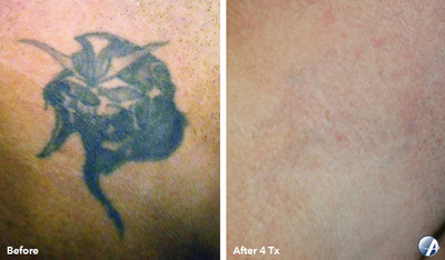 Tattoo removal before and after result 9
