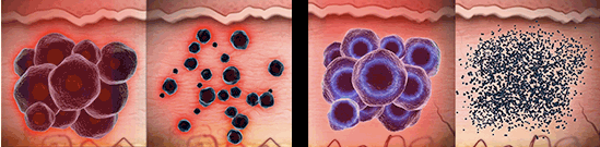 Microscopic comparison of ink shattering: competitor's laser versus the Astanza Duality laser used at Elimination Station.