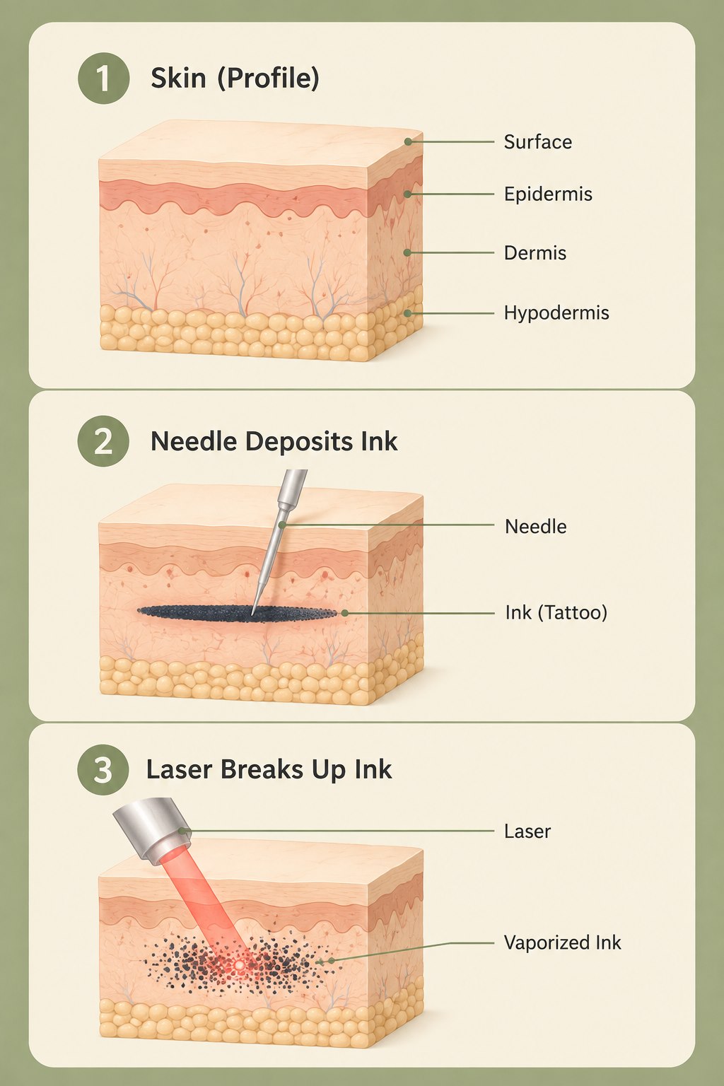 Three-panel diagram of laser tattoo removal. 1: a skin cross-section labelling the surface, epidermis, dermis and hypodermis. 2: a needle depositing tattoo ink into the dermis. 3: a laser breaking that ink into tiny vaporized particles.