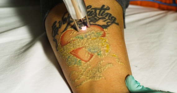 Tattoo ink turning white on the skin's surface during laser treatment.