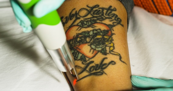example at start of laser tattoo removal treatment process 