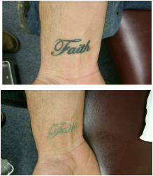 laser snow first treatment tattoo removal