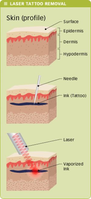 how laser tattoo removal works at elimination station